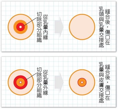 乳暈 黑點|乳暈